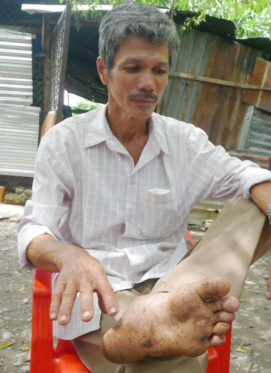 thay giao di lac trong rung o phu quoc ban chan co dau hieu nhiem trung