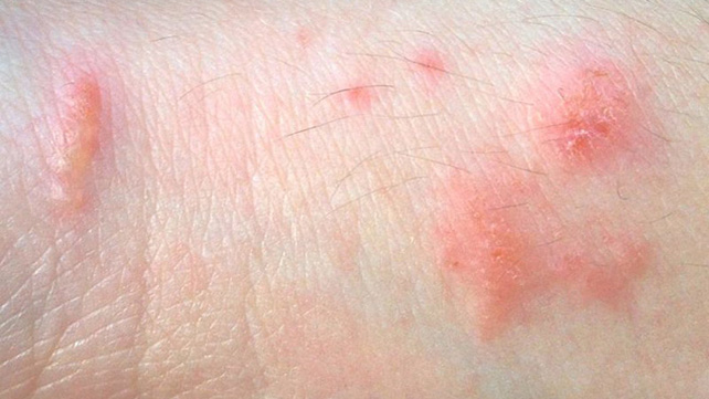 Nguyên nhân của bệnh phát ban sinh dục nguyen nhan cua benh phat ban sinh duc