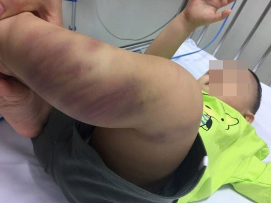 khoi to vu an be trai hon 1 tuoi bi bao hanh da man