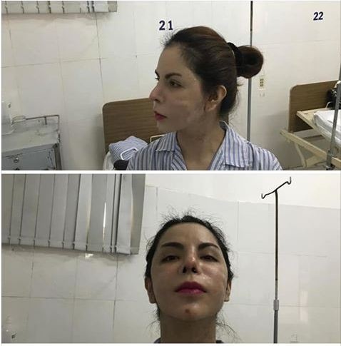 cu dan mang soc voi khuon mat hien tai cua hotgirl chuyen gioi linda khi bi bien dang vi nao silicon