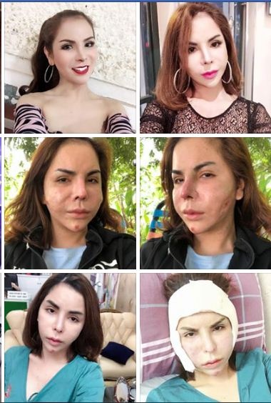 cu dan mang soc voi khuon mat hien tai cua hotgirl chuyen gioi linda khi bi bien dang vi nao silicon
