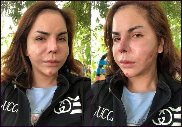 cu dan mang soc voi khuon mat hien tai cua hotgirl chuyen gioi linda khi bi bien dang vi nao silicon