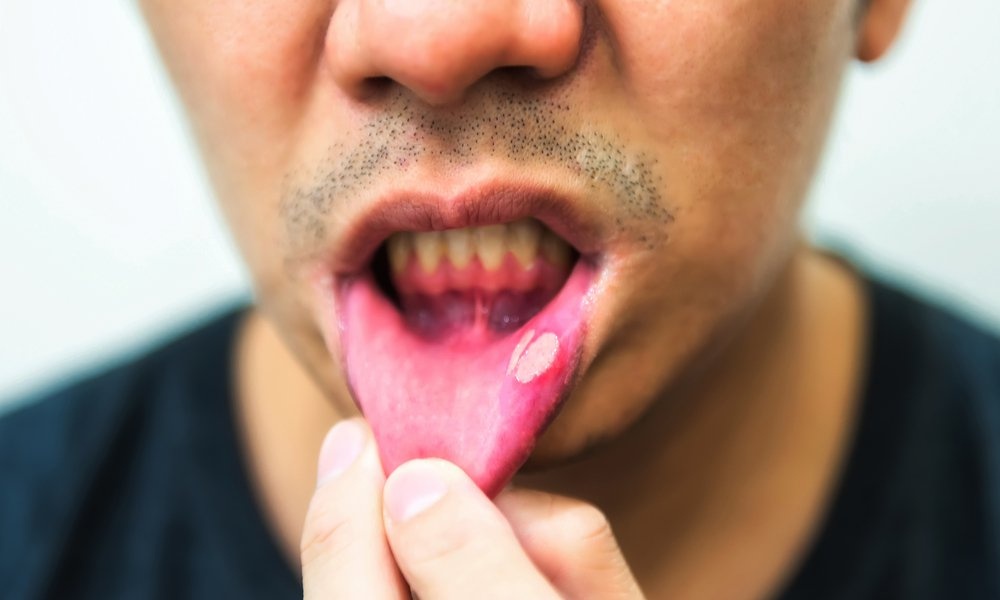 15 trieu chung cho thay nam gioi nhiem hiv trong giai doan dau