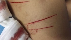 Nữ sinh tố bị kẻ biến thái rạch đùi trong đêm