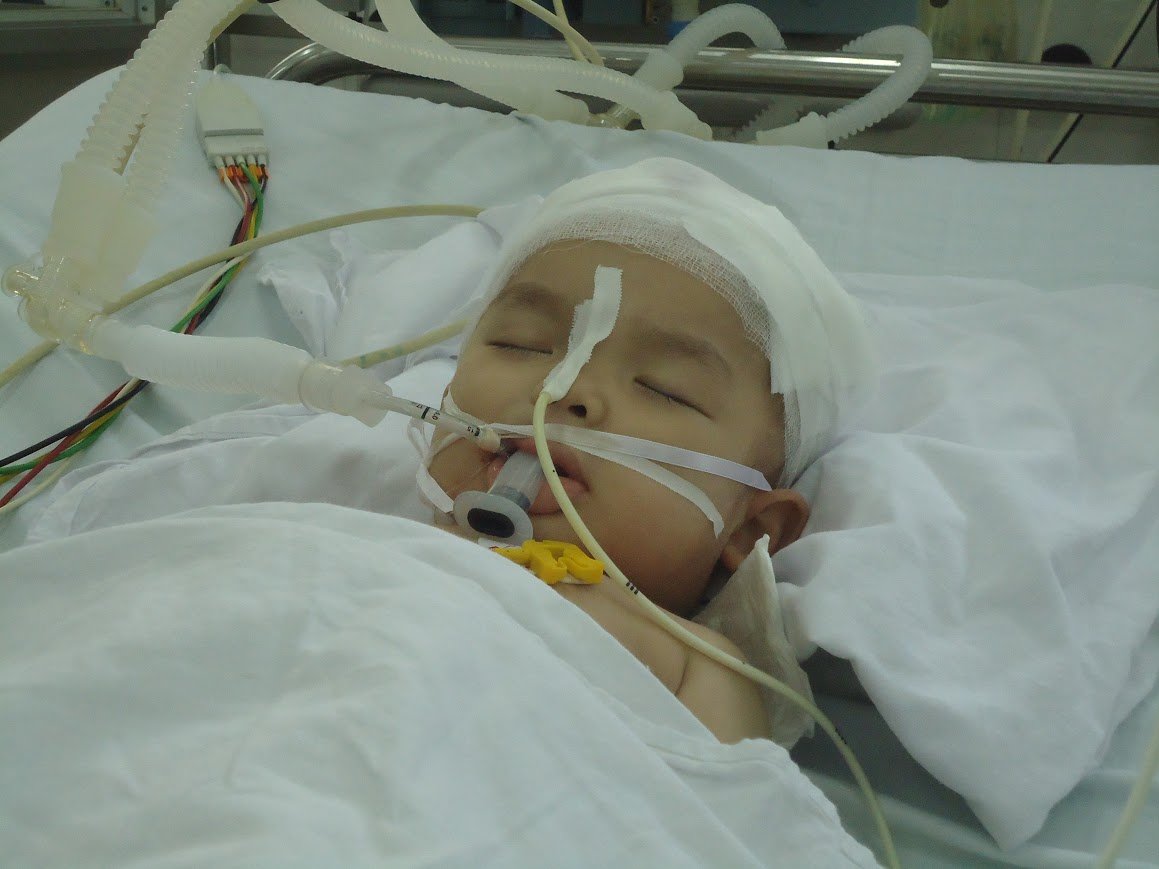 bi tivi roi trung dau be trai 22 thang tuoi chan thuong so nao nguy kich