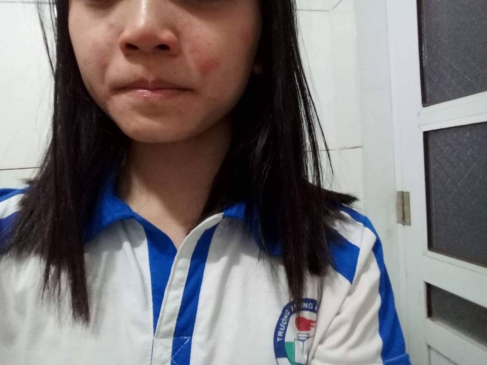 hang loat hoc sinh bi man ngua sau khi nha truong phun thuoc muoi