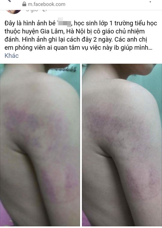 ha noi xon xao hinh anh be lop 1 bi giao vien danh den bam tim tay