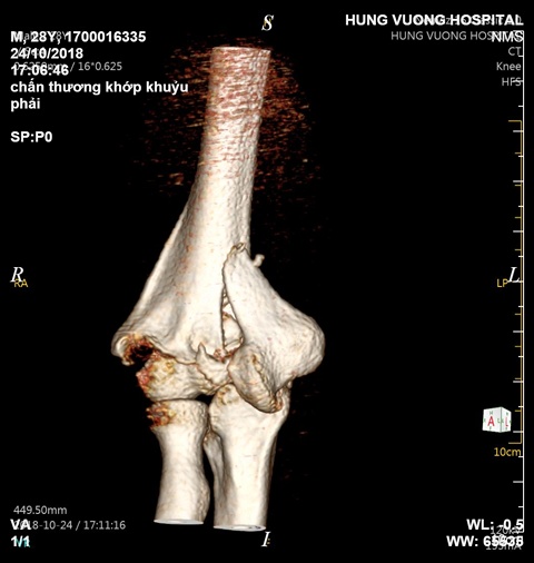 Đi bộ chơi bị té ngã, đừng tưởng bệnh đơn giản di bo choi bi te nga dung tuong benh don gian